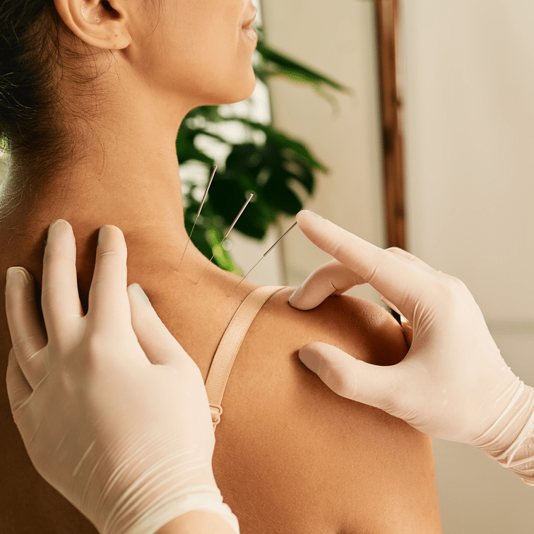 Acupuncture at Live Well Wellness Center